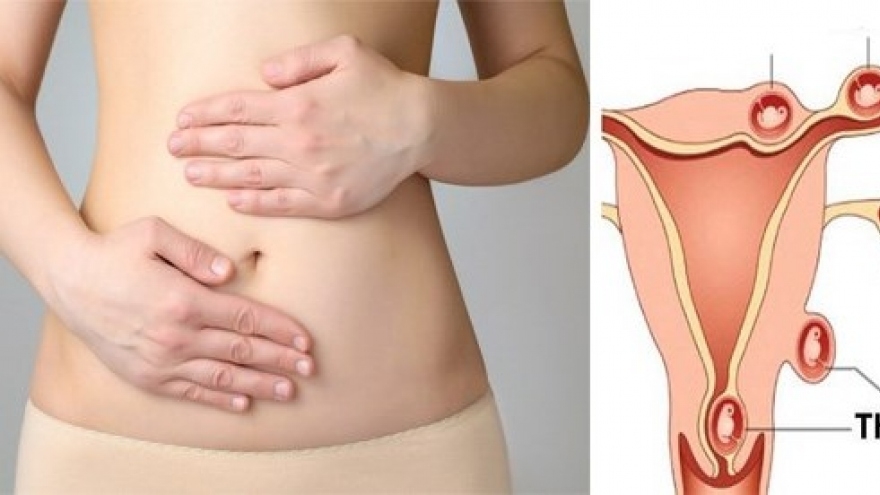 Phụ nữ có tiền sử chửa ngoài tử cung, có thể mang thai tự nhiên được không?