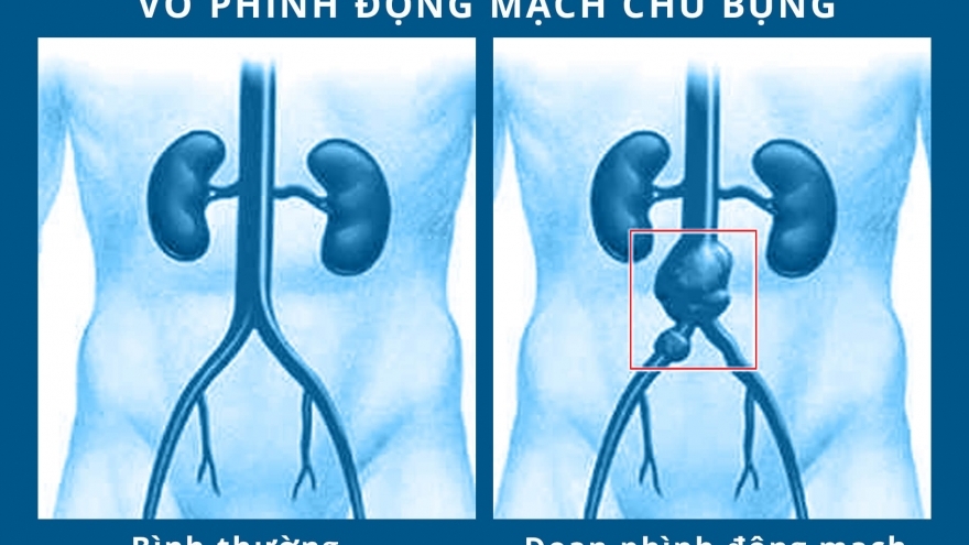 Bệnh phình động mạch chủ bụng và nguy cơ đối với việc quan hệ tình dục