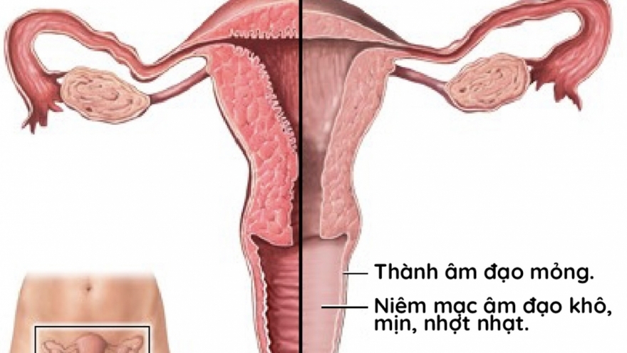 Biểu hiện khiến "cô bé" bị khô, teo, giảm ham muốn