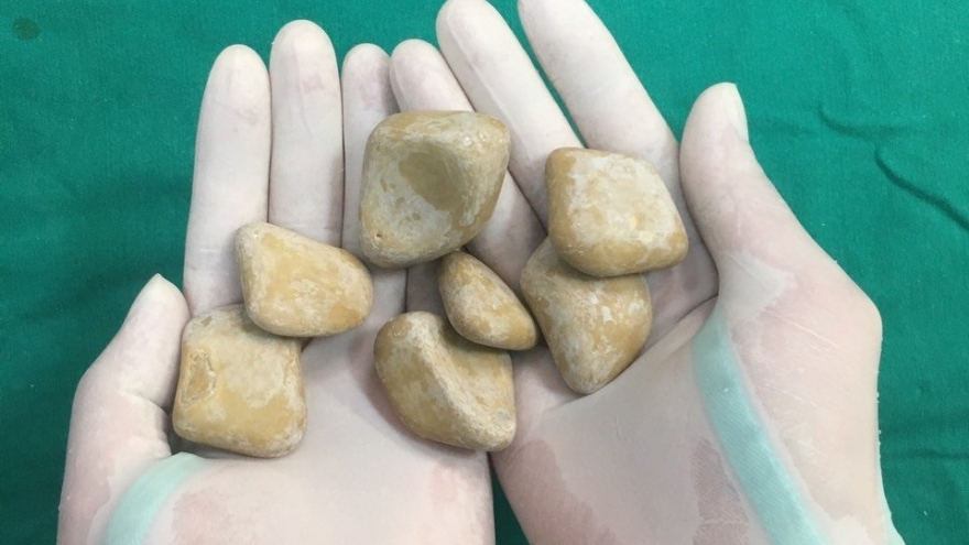 Sỏi bàng quang - kẻ thù tiềm ẩn làm rối loạn "chuyện yêu"