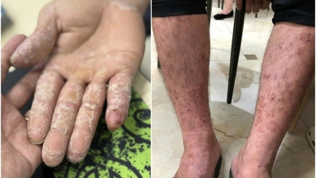 Những bệnh về da thường gặp sau mưa lũ