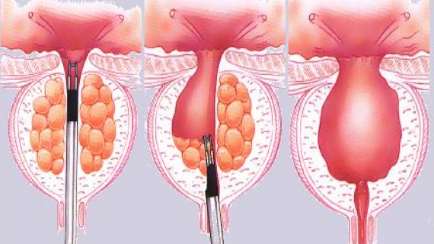Những nguy cơ cần lưu ý sau khi phẫu thuật cắt tiền liệt tuyến