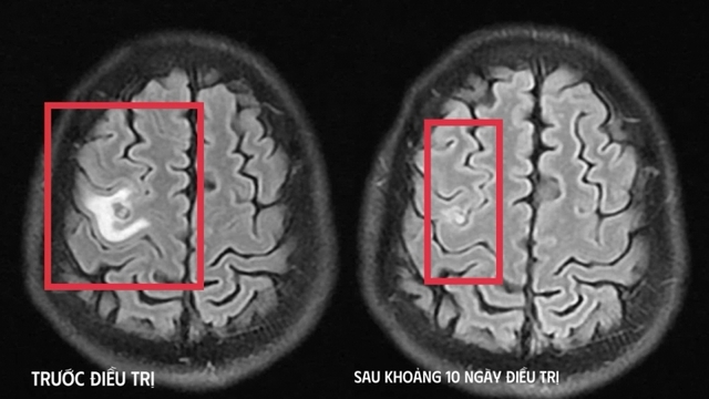 Phát hiện tổn thương não do ký sinh trùng từ triệu chứng giống u não