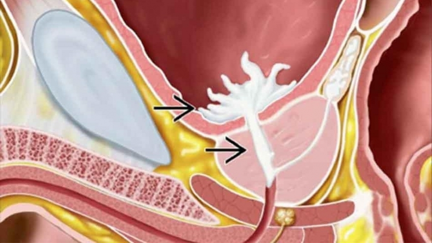 Xuất tinh ngược dòng - biến chứng sau phẫu thuật u xơ tiền liệt tuyến