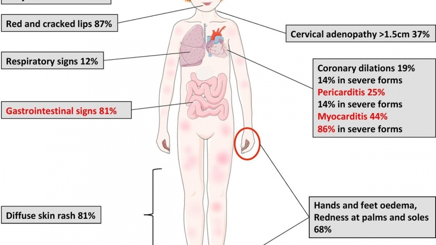 Australia ghi nhận bệnh hiếm gặp liên quan đến Covid-19