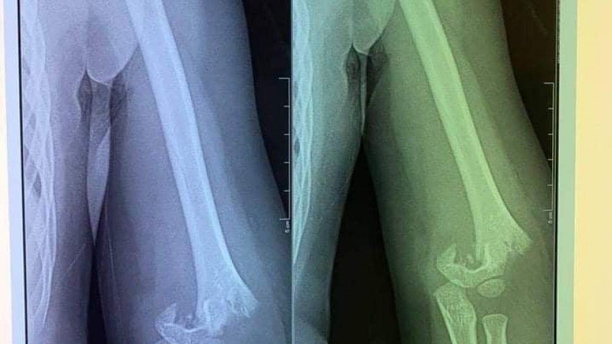 Trường Kid’s Garden từ chối trả lời vụ bé 5 tuổi ngã gãy tay