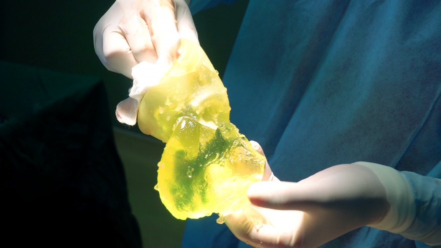 Một phụ nữ bị vỡ túi ngực, silicon công nghiệp tràn ra hố nách