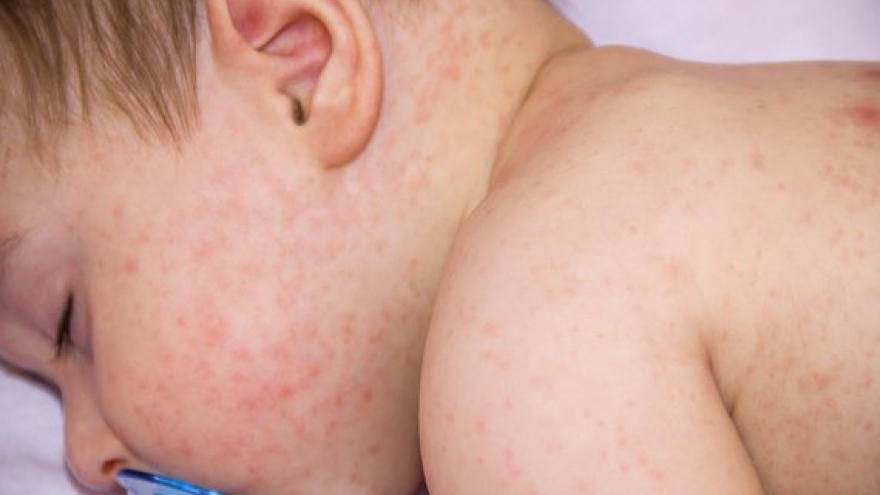 Số ca nhiễm sởi gia tăng do nhiều trẻ em không được tiêm phòng vì Covid-19