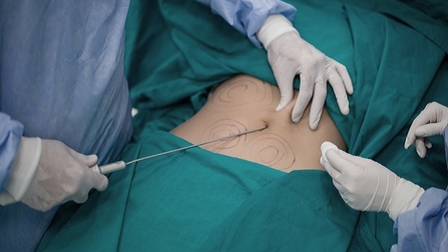 Người phụ nữ 50 tuổi tử vong sau 3 ngày hút mỡ bụng