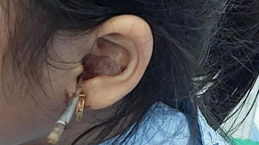 Cấp cứu bé gái bị dị vật xuyên ống tai kẹt vào hòm nhĩ