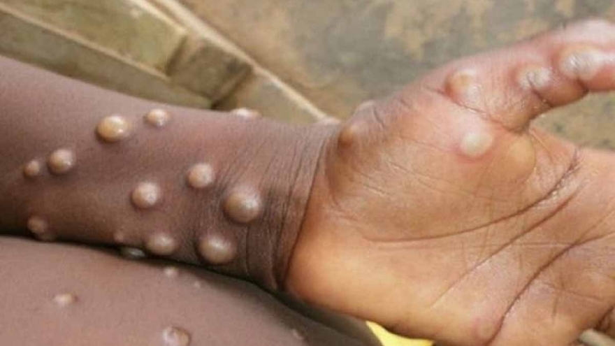 Ấn Độ giám sát sân bay, cửa khẩu để ngăn đậu mùa khỉ