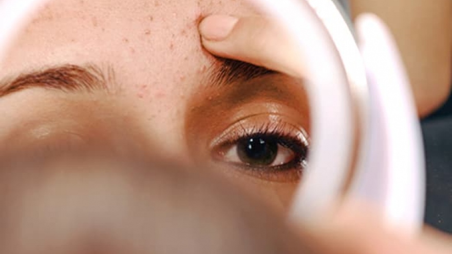 Thực phẩm nên và không nên ăn trong khi điều trị mụn trứng cá