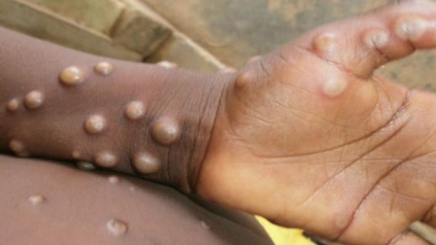 Mỹ cảnh báo đậu mùa khỉ có thể biến đổi chống thuốc kháng virus