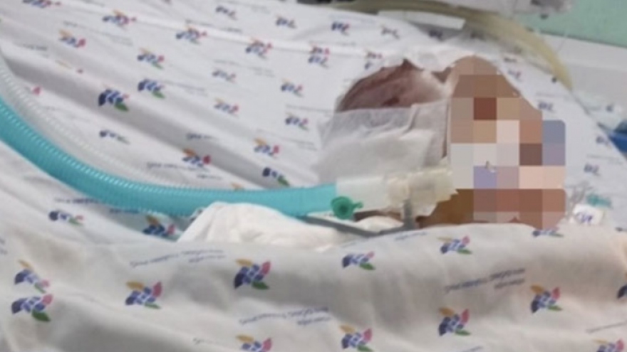 Bảo mẫu bạo hành bé trai 6 tháng tuổi đến xuất huyết não khai gì?