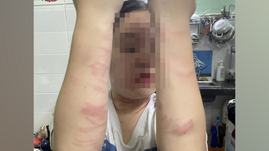 Điều tra vụ nữ sinh 17 tuổi nghi bị mẹ đánh thương tích ở TP.HCM