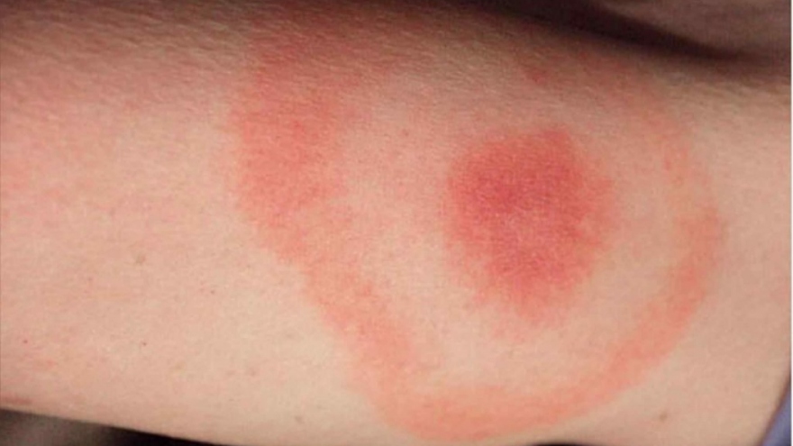 Không chủ quan khi trẻ bị côn trùng đốt