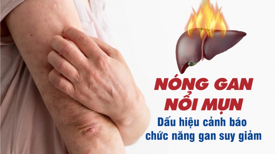 Nóng gan nổi mụn - Dấu hiệu bệnh lý gan mật, đừng xem thường