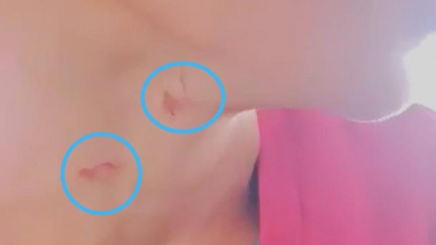 Bé trai 14 tuổi bị cha dượng bạo hành, dùng bật lửa đốt vùng kín