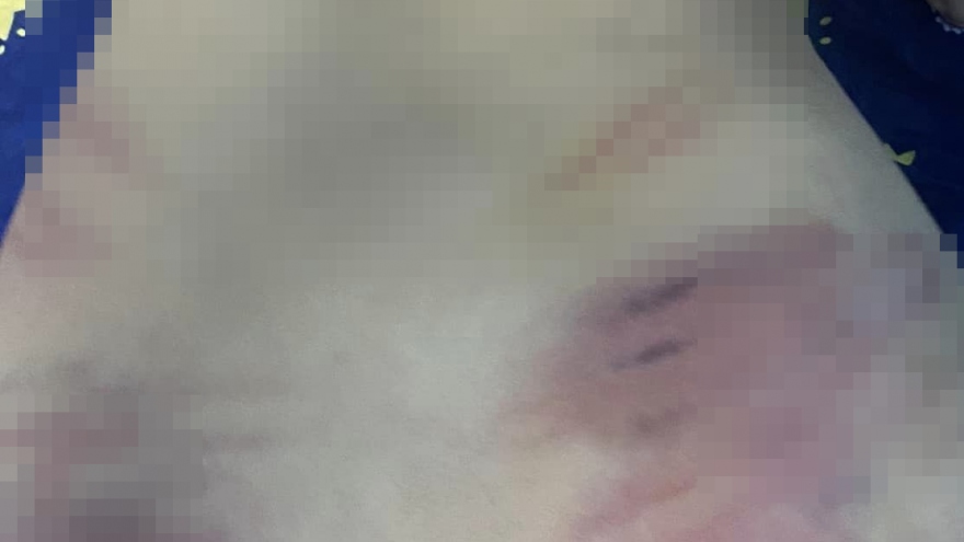 Gia đình tố cáo cô giáo dạy trẻ tự kỷ bạo hành bé trai 9 tuổi