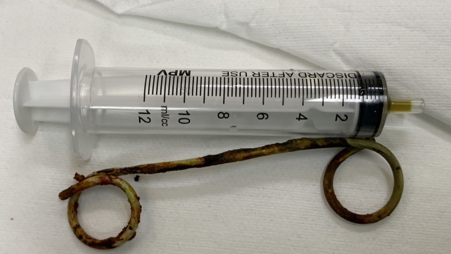 Phẫu thuật lấy stent bị bỏ quên suốt 6 năm trong ống mật của cụ bà 77 tuổi