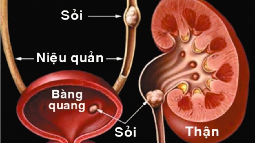 Vì sao tỷ lệ dân số mắc sỏi tiết niệu, sỏi thận tại nước ta ở mức cao?