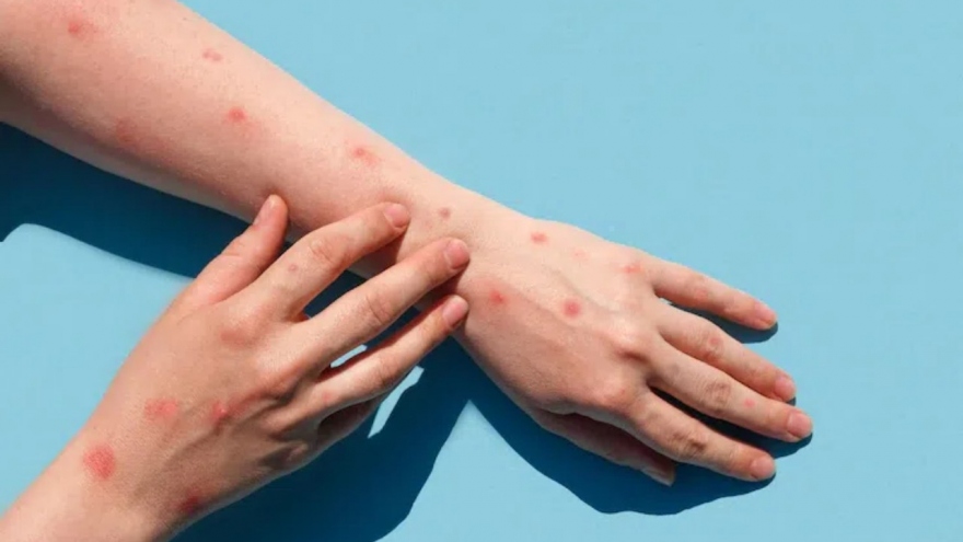 Long An phát hiện ca đậu mùa khỉ đầu tiên