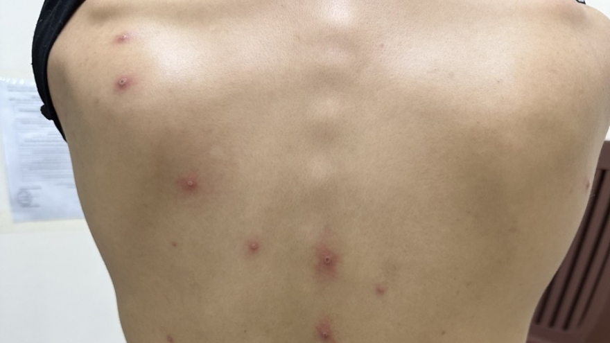 Chủ động sàng lọc, phòng chống bệnh đậu mùa khỉ