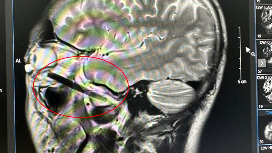 Đũa dài 6cm đâm vào hốc mắt, người đàn ông ở Bình Dương không hay biết