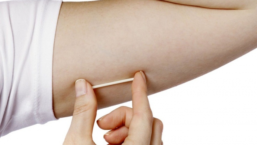 Cấy que tránh thai có an toàn không và tác dụng phụ thế nào?