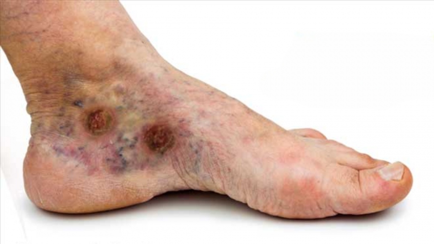 Biến chứng và rủi ro tiềm ẩn trong việc điều trị suy giãn tĩnh mạch nông độ 1