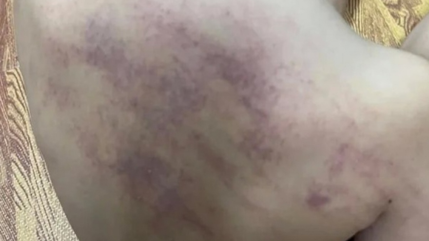 Kết luận vụ bé 5 tuổi bị bầm tím ở lưng sau khi đi học ở Hải Phòng