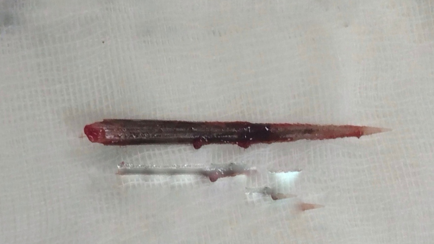 Súyt mất mạng vì bị đuôi cá đuối đâm thủng phổi