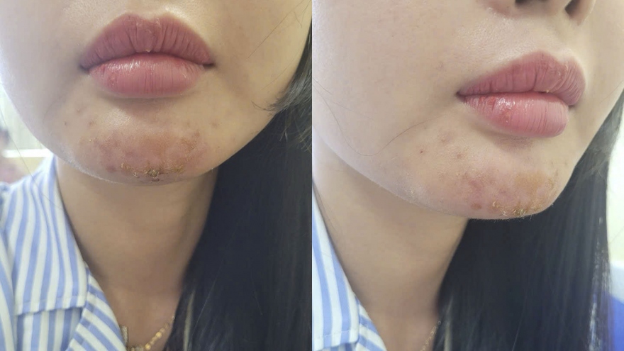 Tiêm chất làm đầy không rõ nguồn gốc, một nữ bệnh nhân nhập viện