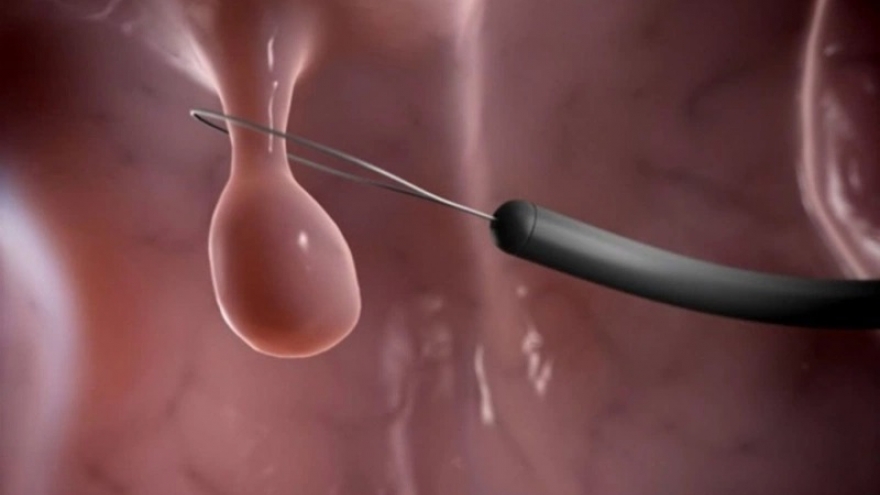 Phẫu thuật cắt polyp tử cung và những điều cần biết