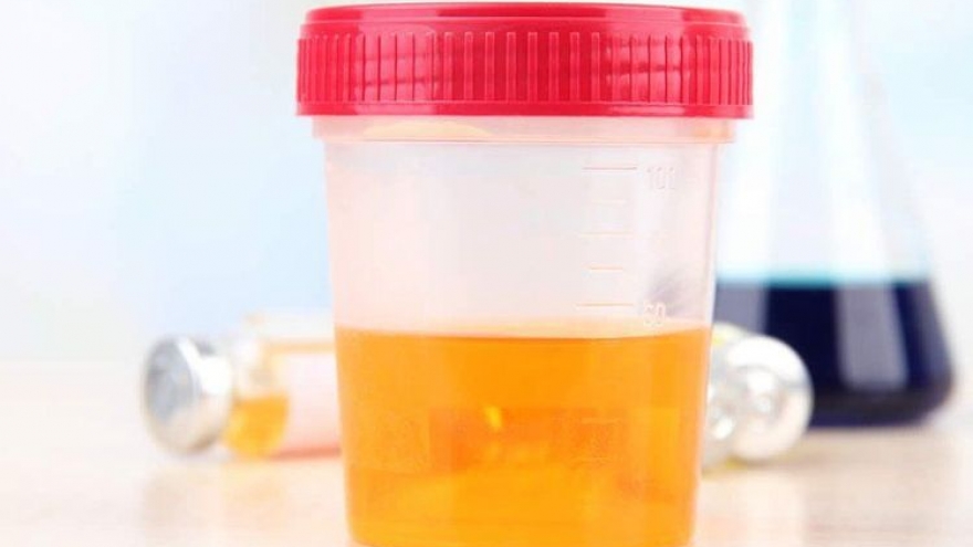 Dấu hiệu của bệnh viêm tiền liệt tuyến ở nam giới