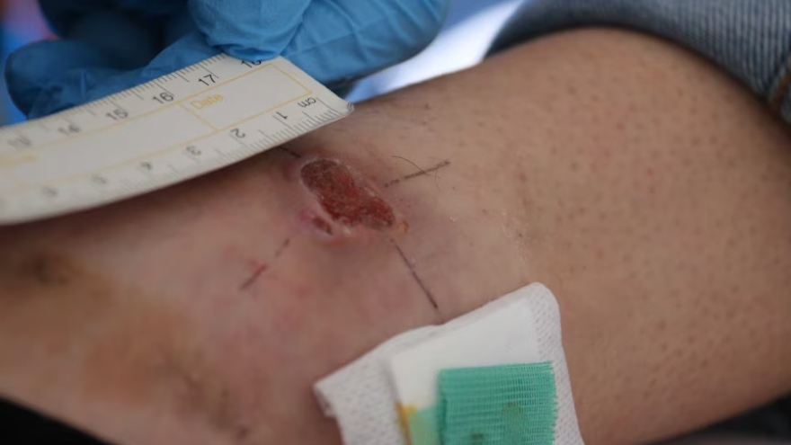 Australia cảnh báo nguy cơ bùng phát dịch lở loét Buruli