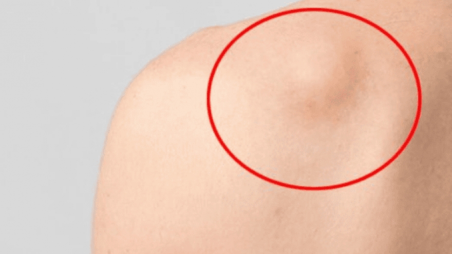 U lành tính sau khi phẫu thuật cắt bỏ có tái phát không?