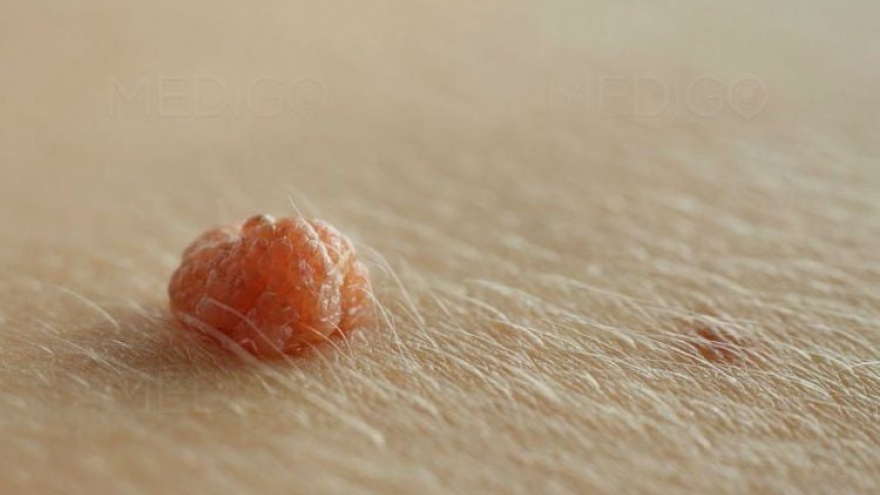 Tôi mất khả năng làm mẹ vì lây bệnh sùi mào gà từ chồng