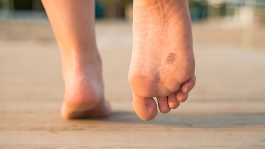 6 thay đổi trên chân ngỡ bình thường lại là dấu hiệu của ung thư ít người biết