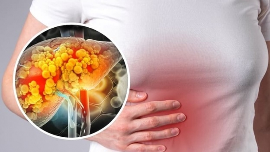 5 loại lá thảo dược là “khắc tinh”của gan nhiễm mỡ, ở Việt Nam cực nhiều