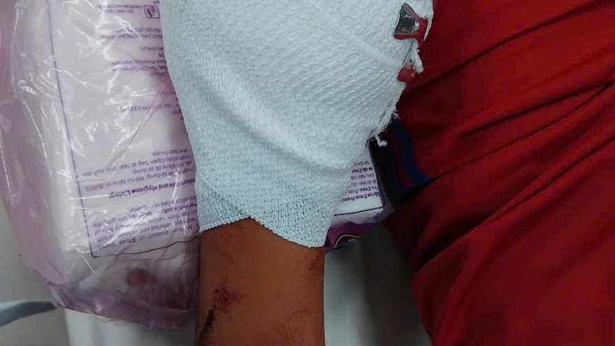 Một nạn nhân bị thương tích nặng do đốt pháo "tự chế” đón giao thừa