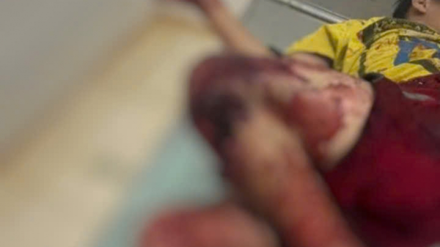 4 học sinh tại Gia Lai bị thương vì tự chế tạo pháo nổ