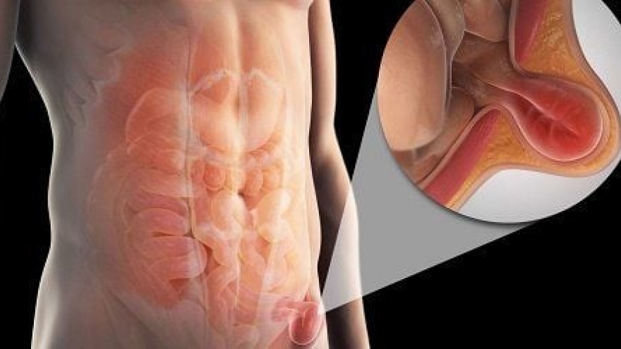 Sau phẫu thuật thoát vị bẹn có ảnh hưởng đến khả năng có con hay không?