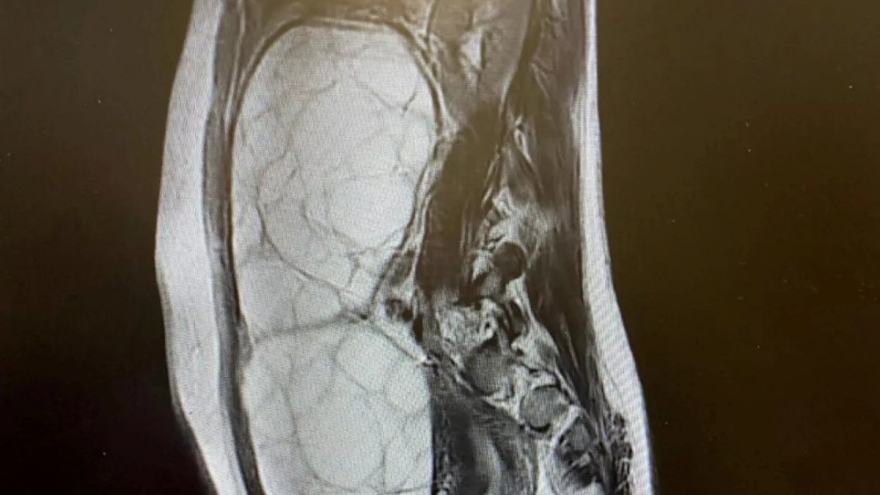 Đi khám vì đầy bụng, nữ sinh bàng hoàng nhận tin chỉ còn 1 tuần để sống