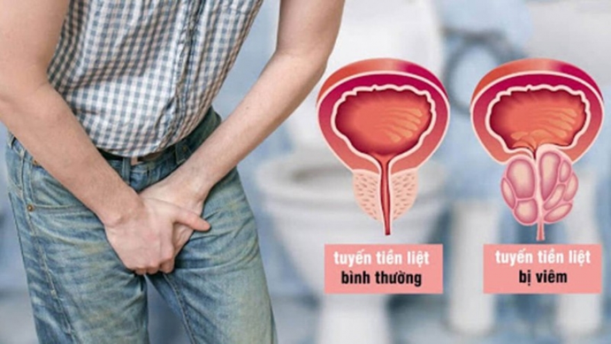 Cách nhận biết sớm bệnh viêm tiền liệt tuyến và xử trí thế nào?