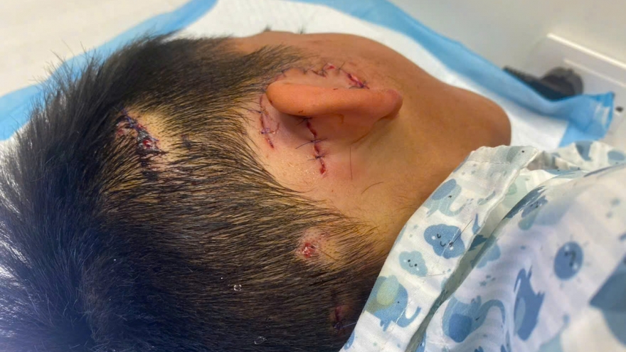 Bé trai 8 tuổi suýt bị mất tai do bị chó nhà cắn