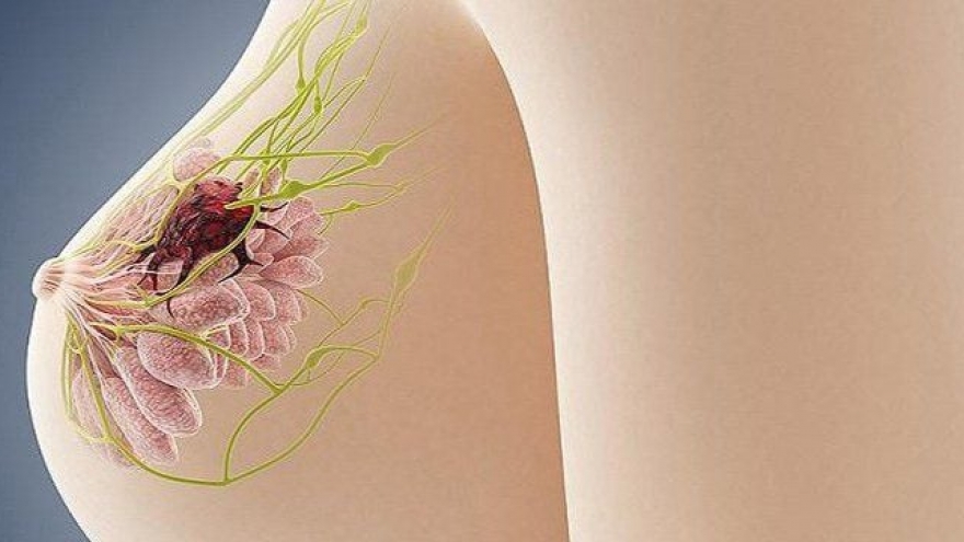 Phát hiện u xơ tuyến vú lành tính, có nên phẫu thuật cho yên tâm?