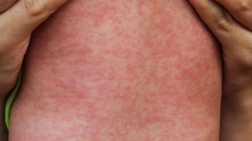 Cả nước có 8 trường hợp tử vong liên quan đến sởi