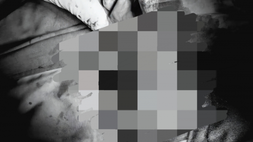 Cấp cứu thành công ca gãy dương vật do té ngã