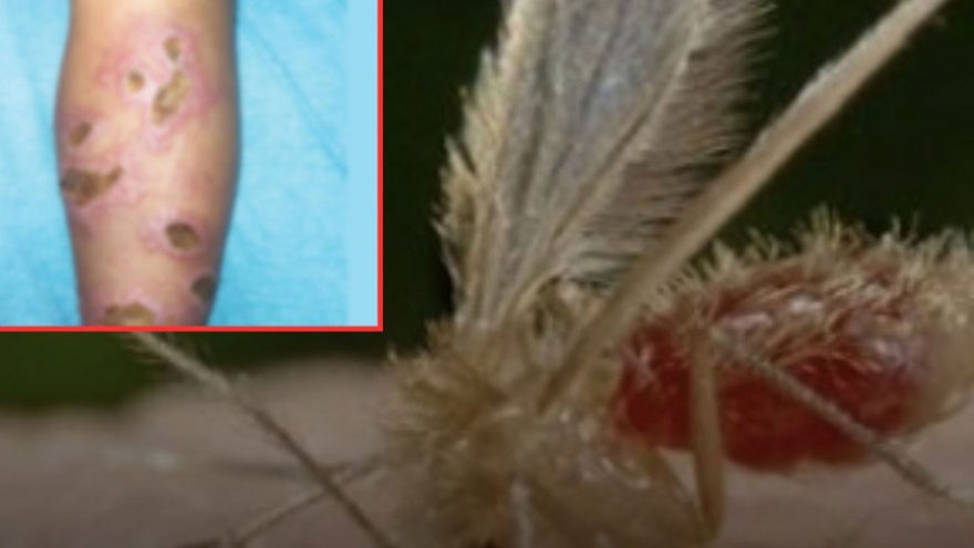 Thái Lan cảnh báo bệnh nhiễm ký sinh trùng Leishmania sau 2 trường hợp tử vong